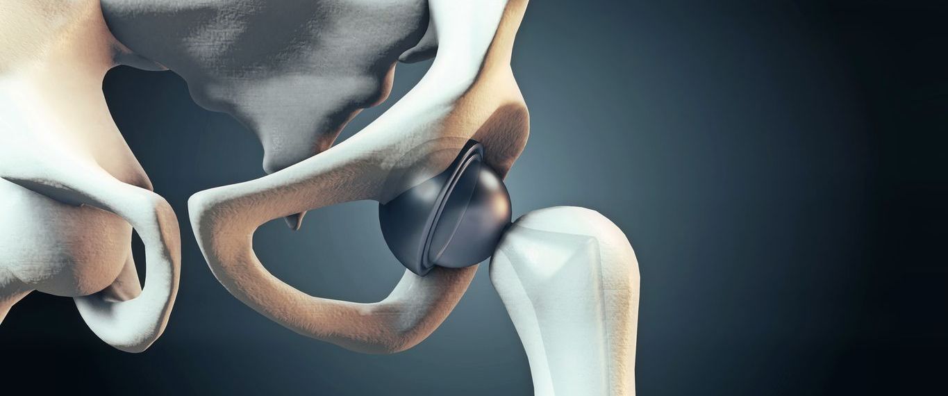 Tu cirugía de prótesis de cadera con SAP Fonasa