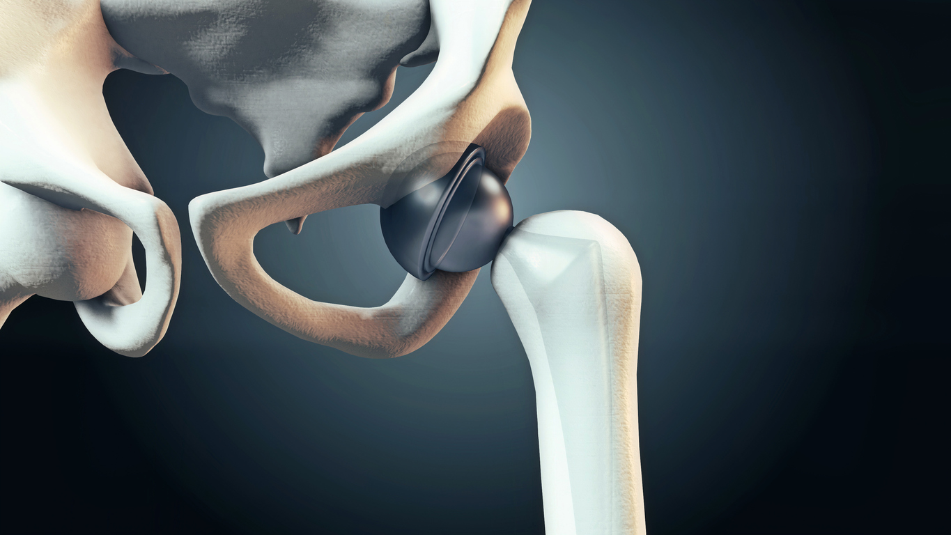 Tu cirugía de prótesis de cadera con SAP Fonasa